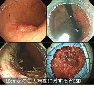 10㎝超の巨大病変に対する胃ESD