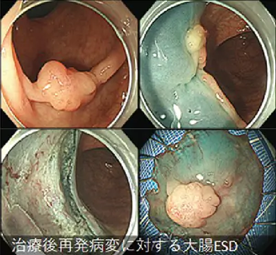 治療後再発病変に対する大腸ESD