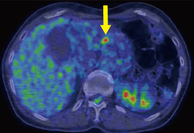 図１.　検診PET-CT 膵体部にFDGの集積（矢印）を認める