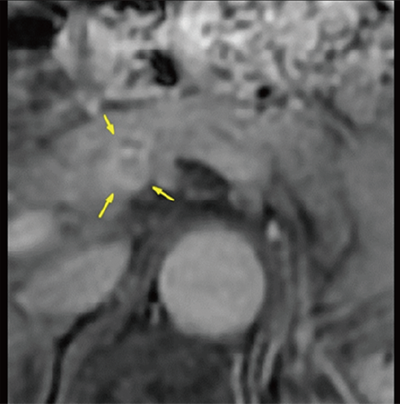 図２.　腹部造影MRI 矢印：PET-CTで指摘された同部位に膵腫瘍を認め膵臓がんが疑われる