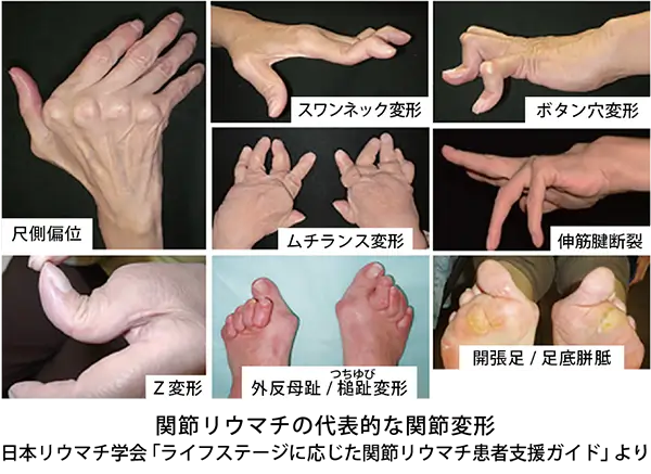 関節リウマチは早期診断、早期治療が大事!というのには、そういった背景があるのです。
