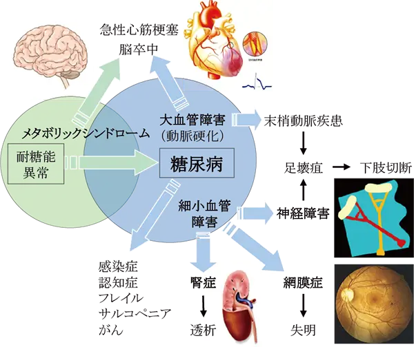 耐糖能異常/糖尿病とその合併症