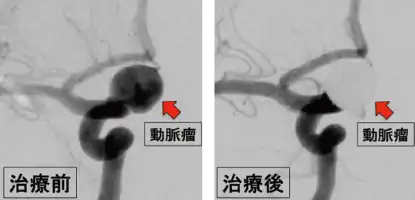 脳血管内治療前と治療後のMRI画像