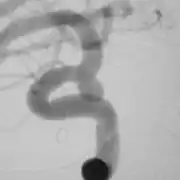 治療する前の脳動脈瘤の症例