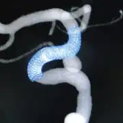 カテーテルを通じてフローダイバーターを展開留置直後の映像