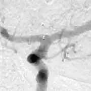 6カ月後の血管撮影では脳動脈瘤は消失した映像
