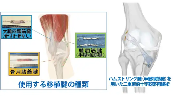 使用する移植腱の種類