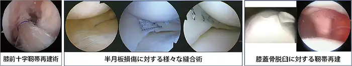 膝前十字靭帯再建術、半月板損傷に対する様々な縫合術、膝蓋骨脱臼に対する靭帯再建