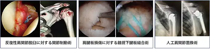 反復性肩関節脱臼に対する関節制動術、肩腱板損傷に対する鏡視下腱板縫合術、人工肩関節置換術