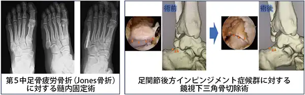 第5中足骨疲労骨折(Jones骨折)に対する髄内固定術、足関節後方インピンジメント症候群に対する鏡視下三角骨切除術