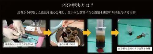 PRP(多血小板血漿)療法とはのイメージ