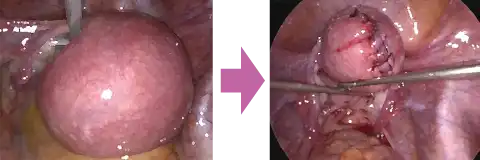 子宮筋腫核出術