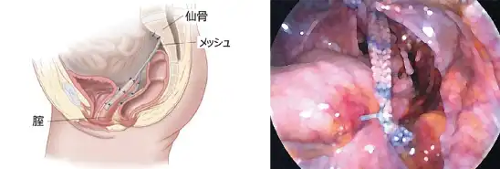 仙骨腟固定術