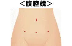 腹腔鏡
