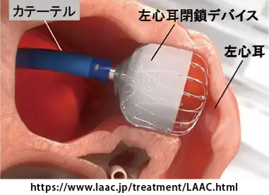 左心耳閉鎖術