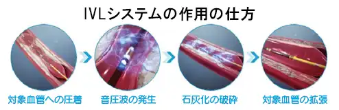 IVL（血管内破砕術）