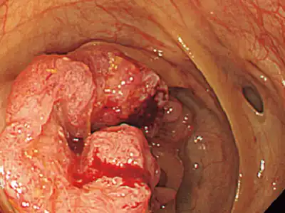 典型的進行大腸がん