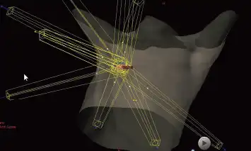 定位放射線治療