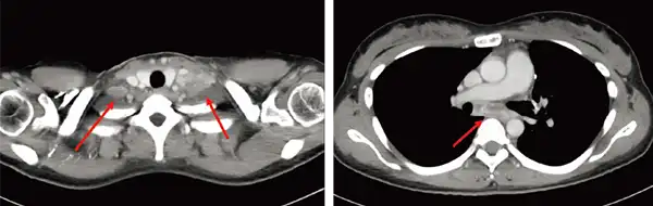 VMATを使った放射線治療