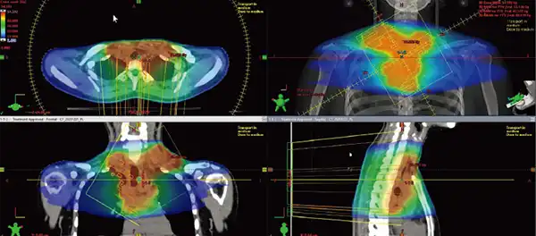 VMATを使った放射線治療