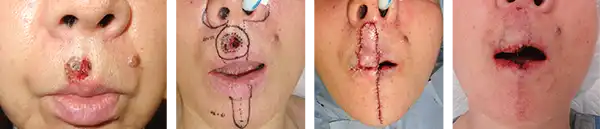 上口唇部の基底細胞がん